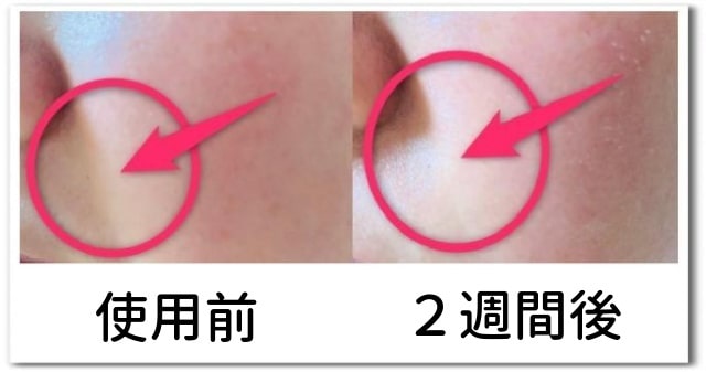 アテニアドレスリフト使用後の肌画像